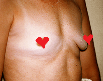 San Diego Breast Augmentation Before