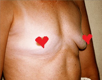 San Diego Breast Augmentation Before