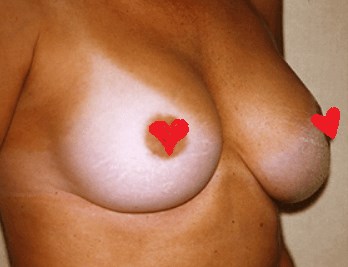 San Diego Breast Augmentation After