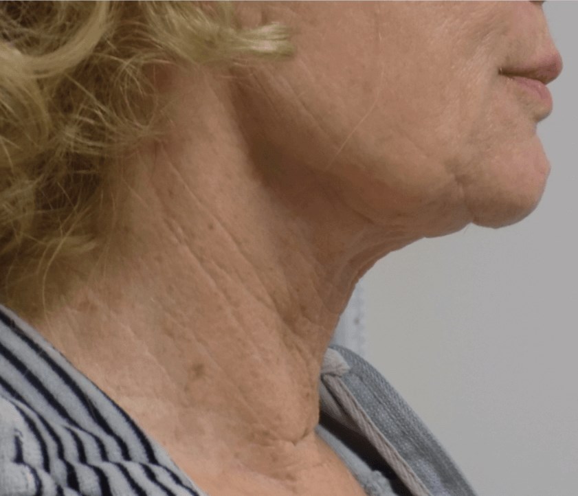 San Diego Natural Neck Lift Before