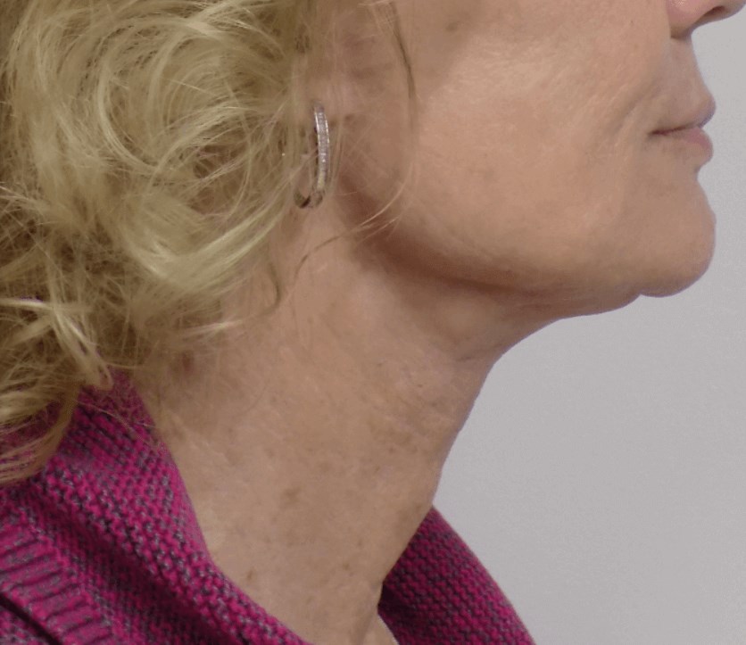 San Diego Natural Neck Lift After