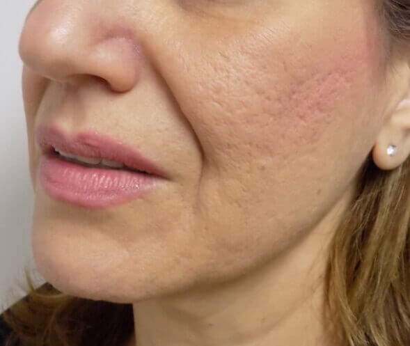 San Diego Scar Laser Treatment Before