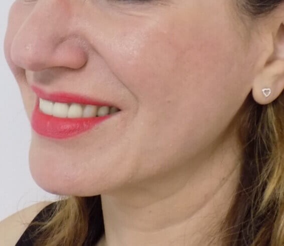 San Diego Scar Laser Treatment After