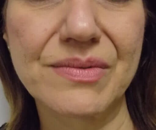 San Diego Scar Laser Treatment Before