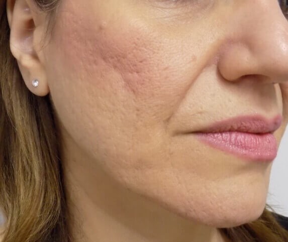 San Diego Scar Laser Treatment Before