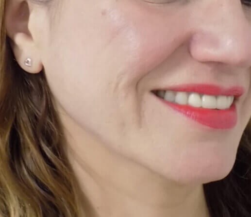 San Diego Scar Laser Treatment After