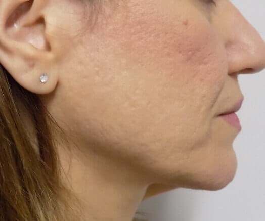 San Diego Scar Laser Treatment Before