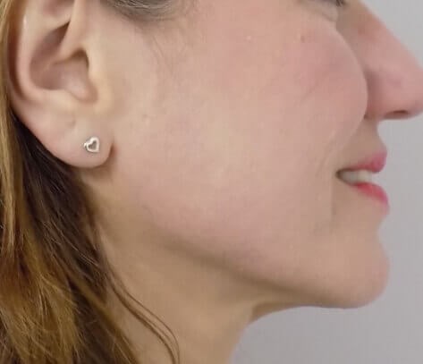 San Diego Scar Laser Treatment After