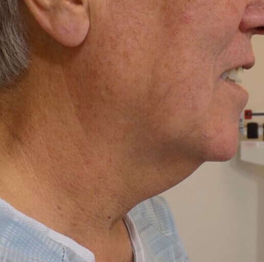 San Diego Neck Lift Before
