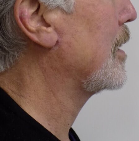 San Diego Neck Lift After