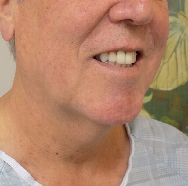 San Diego Neck Lift Before