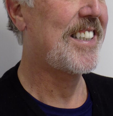 San Diego Neck Lift After