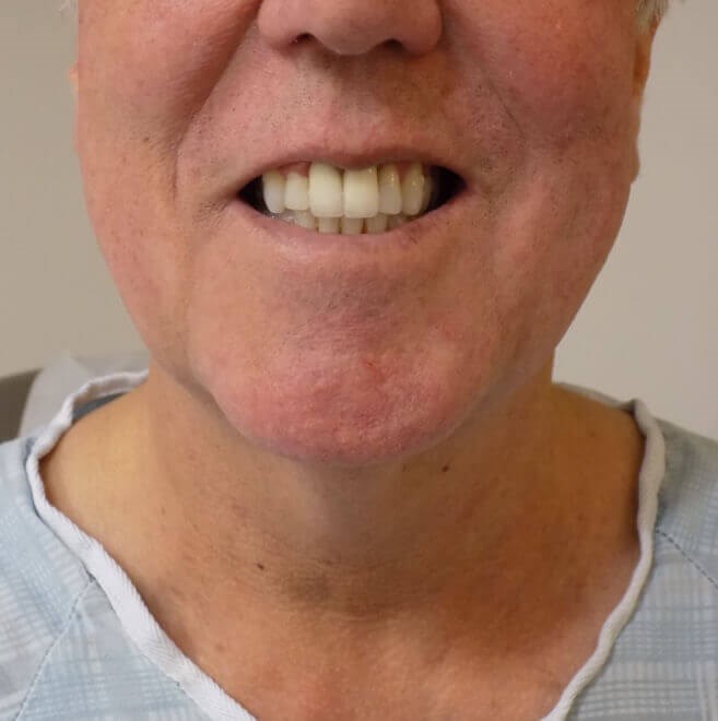 San Diego Neck Lift Before