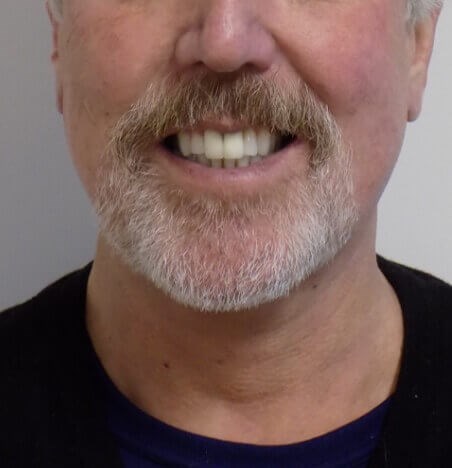 San Diego Neck Lift After