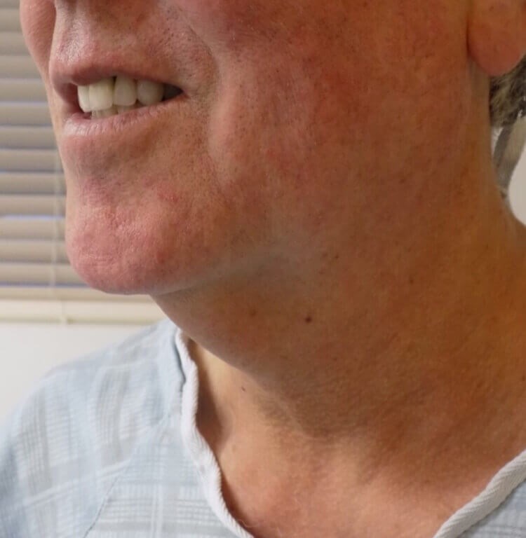 San Diego Neck Lift Before