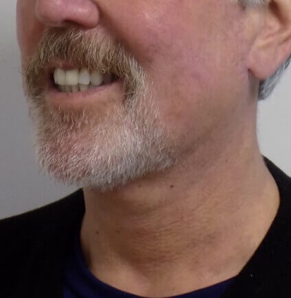 San Diego Neck Lift After