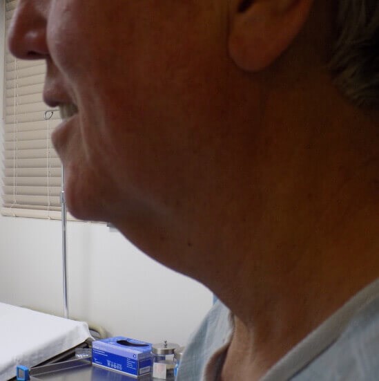 San Diego Neck Lift Before