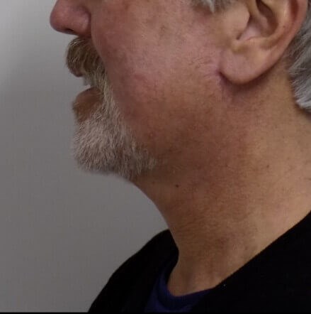 San Diego Neck Lift After