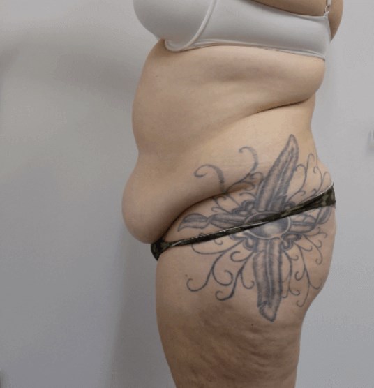 San Diego Mommy Makeover Before