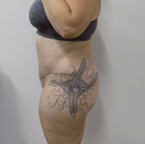 San Diego Mommy Makeover After