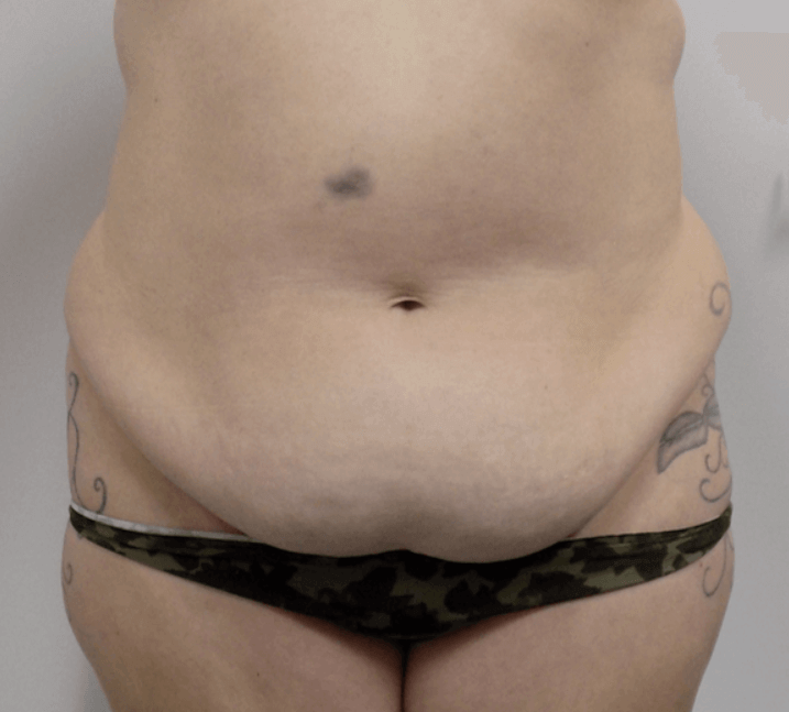 San Diego Mommy Makeover Before