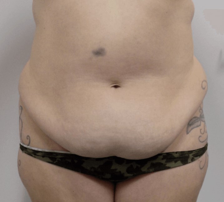 San Diego Mommy Makeover Before