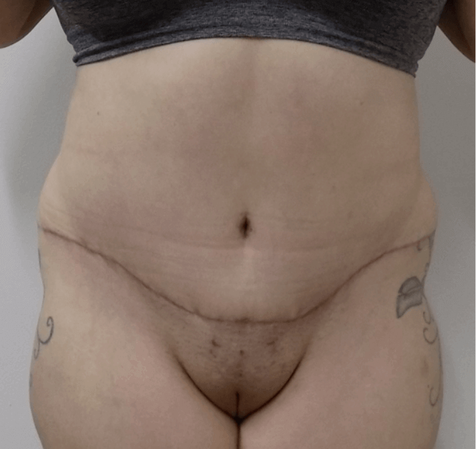 San Diego Mommy Makeover After