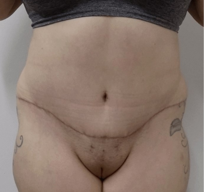 San Diego Mommy Makeover After