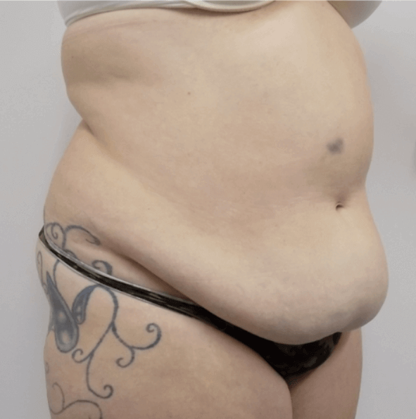 San Diego Mommy Makeover Before