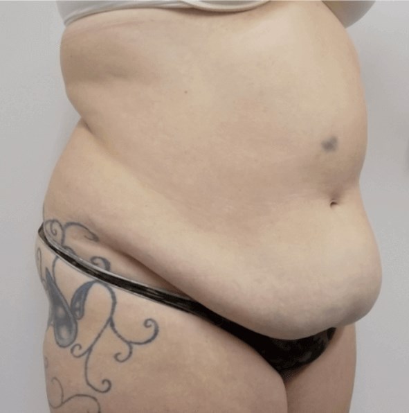 San Diego Mommy Makeover Before