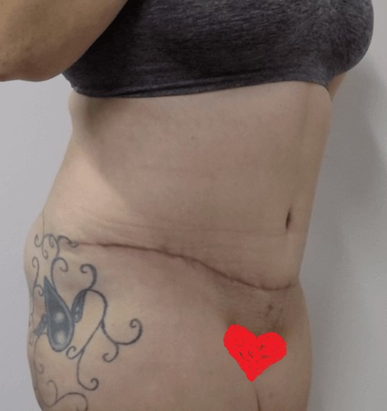 San Diego Mommy Makeover After