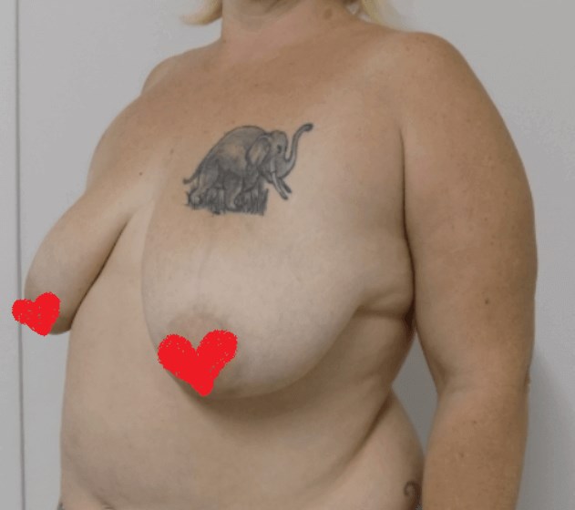 San Diego Mommy Makeover Before