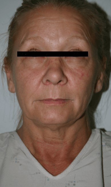 La Mesa Makeover Surgery Before