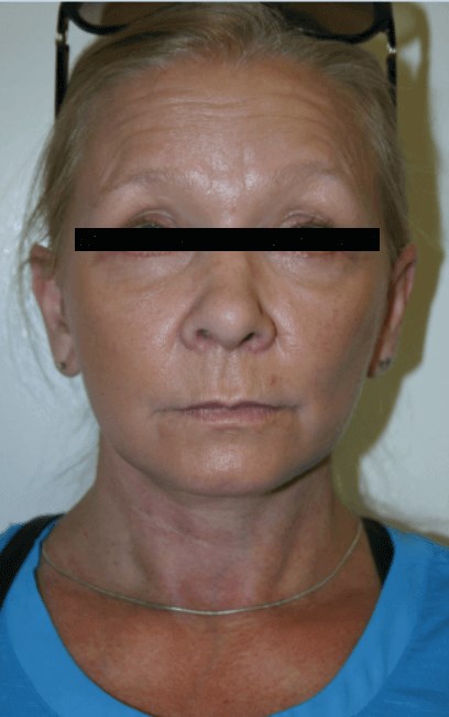 La Mesa Makeover Surgery After