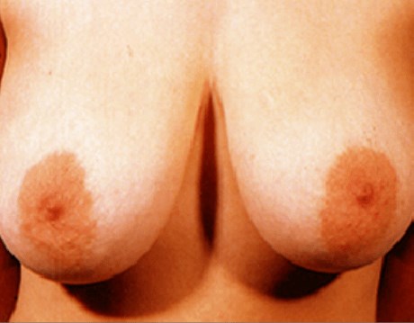 San Diego Breast Lift Before
