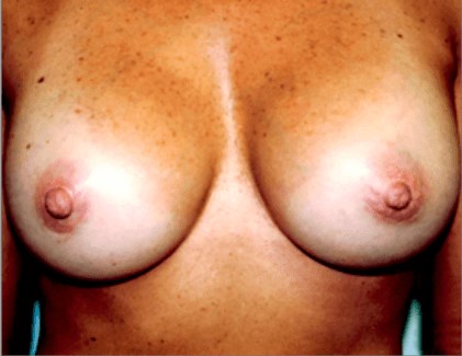 La Mesa Breast Augmentation After