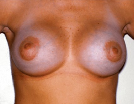 La Mesa Gel Augmentation After