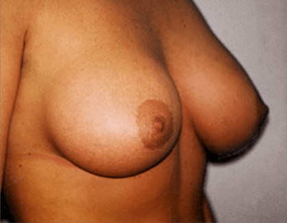 San Diego Breast Job After