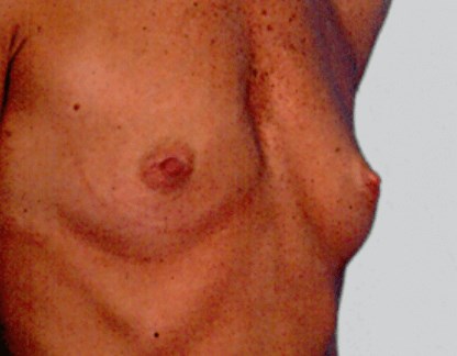 La Mesa Breast Enlargement Before