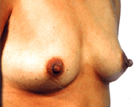 La Mesa Breast Enhancement Before