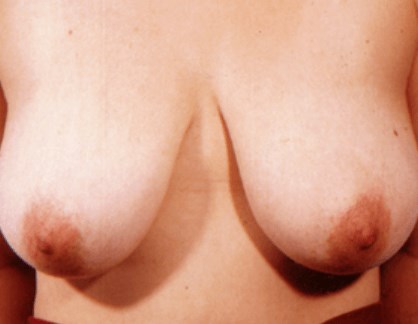 La Mesa Breast Lift Before