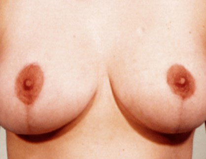 La Mesa Breast Lift After