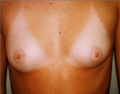 San Diego Breast Aug Before
