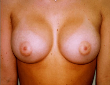 San Diego Breast Aug After