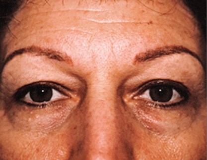 San Diego Eyelid Lift Before