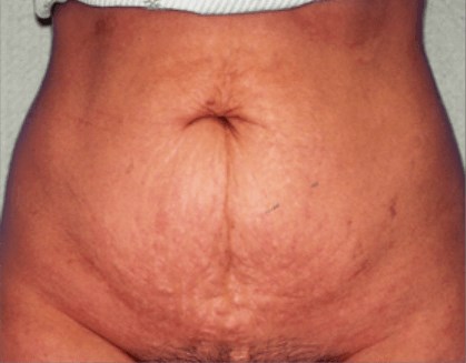 San Diego Abdominoplasty Before