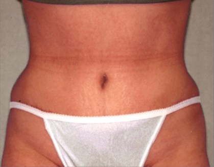 San Diego Abdominoplasty After