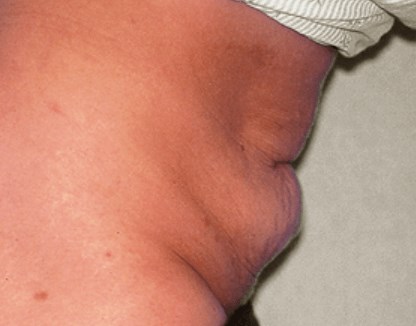 San Diego Abdominoplasty Before