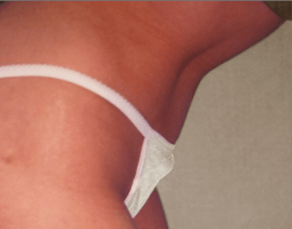 San Diego Abdominoplasty After