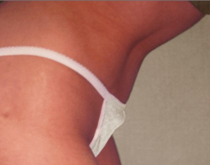 San Diego Abdominoplasty After